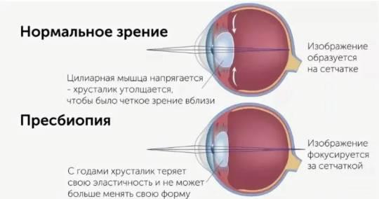 Пресбиопия